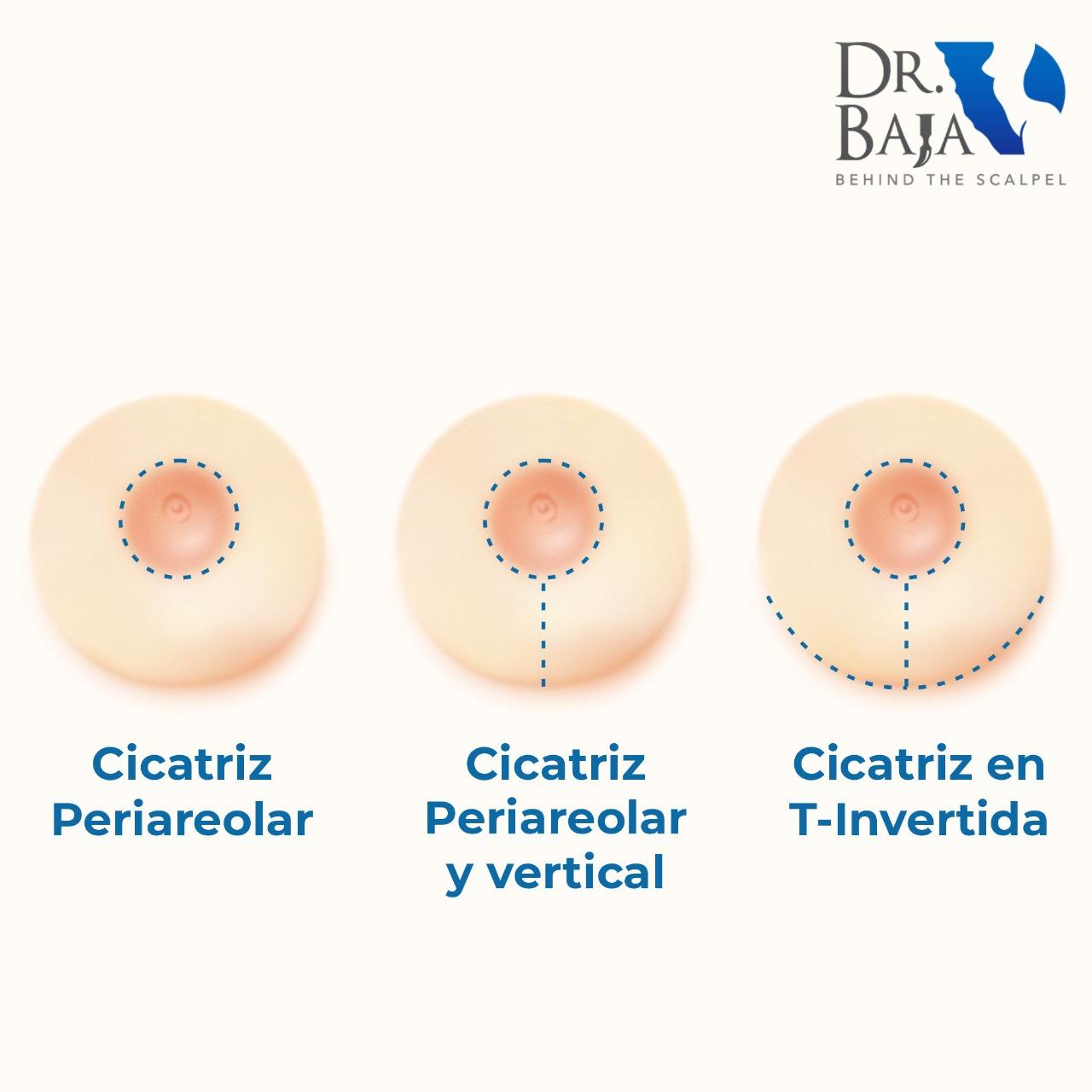 tipos de mastopexia 